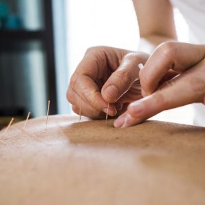 close up of acupuncture treatment