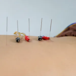 electro acupuncture treatment